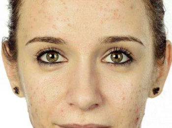 痤疮和毛囊炎的不同分析，区别4点