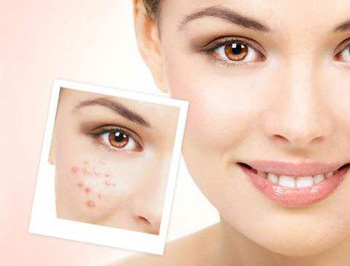 痤疮和毛囊炎的不同分析，区别4点  毛囊炎 痤疮 区别 美白祛黄 第2张