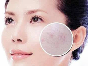 痤疮和毛囊炎的不同分析，区别4点  毛囊炎 痤疮 区别 美白祛黄 第4张