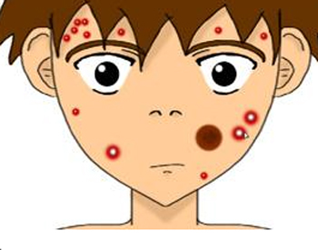 痤疮和青春痘的区别，教你正确辨别痘  痤疮 青春痘 美白祛黄 第3张