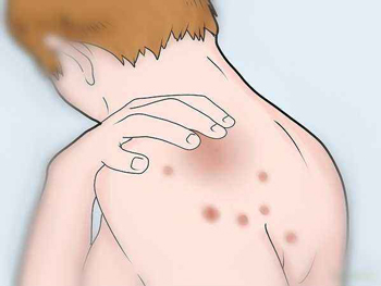 痤疮和青春痘的区别，教你正确辨别痘  痤疮 青春痘 美白祛黄 第5张