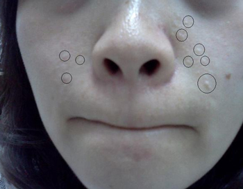 粉刺和痤疮区别，五种区别正确区分疙瘩  痤疮 粉刺 美白祛黄 第2张