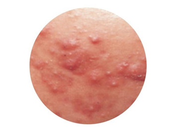 毛囊炎和痤疮的区别，辨别清楚治疗更快  痤疮 美白祛黄 第2张