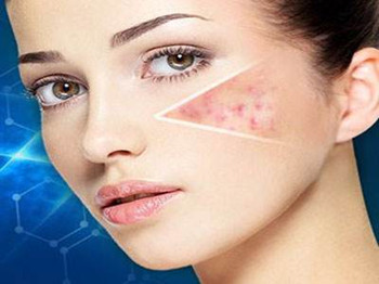 红蓝光治疗痤疮效果详细分析