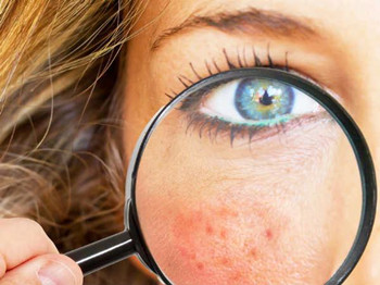 米诺环素治疗痤疮效果如何有没有副作用