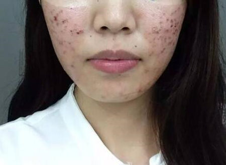 痘坑痘印千万不要做激光磨皮，血泪教训真实记录  痘坑 激光 磨皮 美白祛黄 第2张