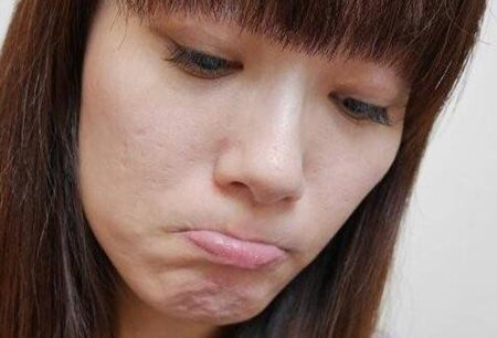 痘坑痘印千万不要做激光磨皮，血泪教训真实记录  痘坑 激光 磨皮 美白祛黄 第3张