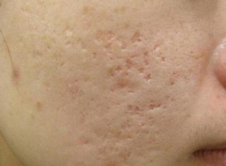 痘坑痘印千万不要做激光磨皮，血泪教训真实记录  痘坑 激光 磨皮 美白祛黄 第5张