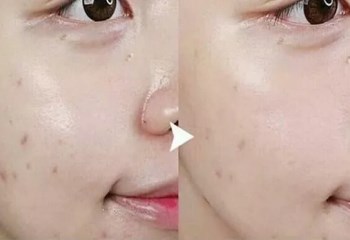 悦诗风吟小白管怎么样，祛痘印效果好吗  祛痘印 小白管 美白祛黄 第3张