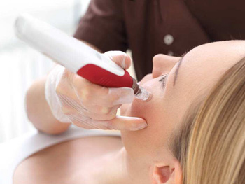 微针祛痘坑几次有效果，怎么护理  祛痘 微针 美白祛黄 第3张