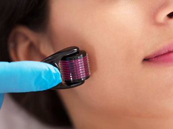 微针祛痘坑几次有效果，怎么护理  祛痘 微针 美白祛黄 第5张