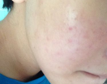 喜辽妥去痘印效果好吗，Hirudoid软膏去痘印必看  喜辽妥 美白祛黄 第2张