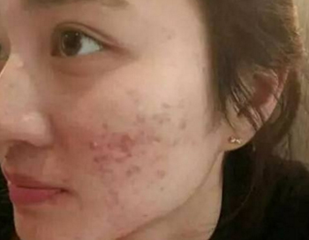 喜辽妥去痘印效果好吗，Hirudoid软膏去痘印必看  喜辽妥 美白祛黄 第5张