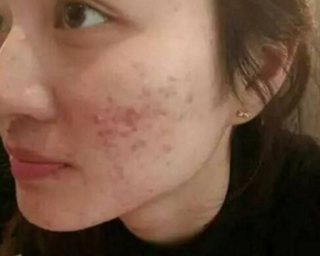 白糖去痘印是真的吗，去痘印不冲动  白糖 痘印 美白祛黄 第2张