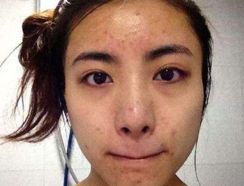 白糖去痘印是真的吗，去痘印不冲动  白糖 痘印 美白祛黄 第5张