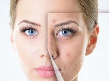 淡化痘印黑色素的方法，别让痘印毁容貌  黑色素 方法 美白祛黄 第1张