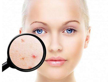 果酸去痘印效果怎么样，有副作用吗  果酸 去痘印 美白祛黄 第1张