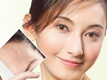 磨皮去痘坑一般能撑多久，磨皮的好与坏  去痘坑 美白祛黄 第1张