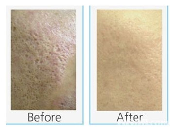 磨皮去痘坑一般能撑多久，磨皮的好与坏  去痘坑 美白祛黄 第2张