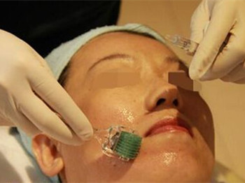 微针去痘坑真的有效吗,要美更要安全 去痘坑 美白祛黄 第3张 微针去痘坑真的有效吗,要美更要安全 去痘坑 美白祛黄 第3张