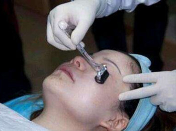 微针去痘坑真的有效吗,要美更要安全 去痘坑 美白祛黄 第4张 微针去痘坑真的有效吗,要美更要安全 去痘坑 美白祛黄 第4张