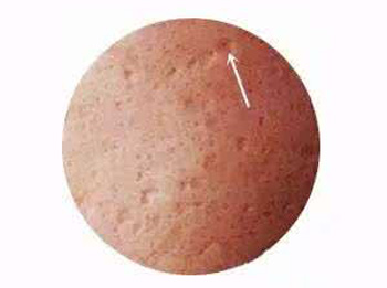 脸上的痘坑可以填平吗，教你3种方法  痘坑 美白祛黄 第1张