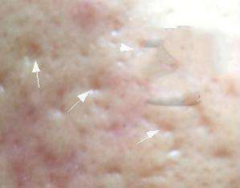 脸上的痘坑可以填平吗，教你3种方法  痘坑 美白祛黄 第2张