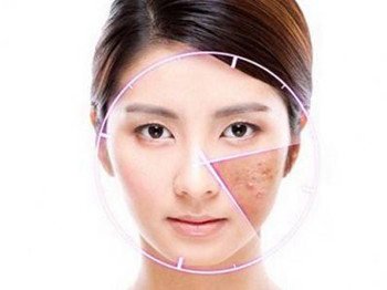 激光祛痘印后几天脱落，需要注意什么  祛痘印 美白祛黄 第1张