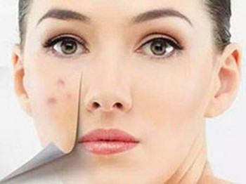 激光祛痘印后几天脱落，需要注意什么  祛痘印 美白祛黄 第2张