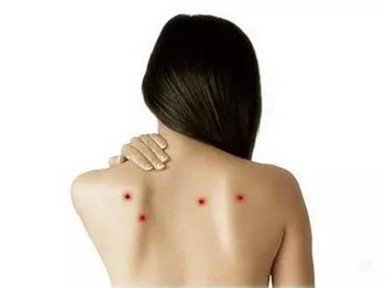 如何去背部痘印,塑造美背 去痘印 美白祛黄 第1张 如何去背部痘印,塑造美背 去痘印 美白祛黄 第1张