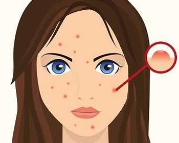 凸起痘疤会自己消失吗,尽早修复最好 痘疤 美白祛黄 第1张 凸起痘疤会自己消失吗,尽早修复最好 痘疤 美白祛黄 第1张