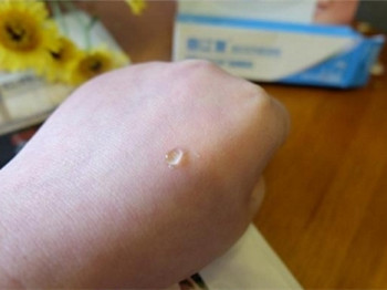 喜辽复可以去痘印吗,药物成分去痘印 去痘印 美白祛黄 第5张 喜辽复可以去痘印吗,药物成分去痘印 去痘印 美白祛黄 第5张