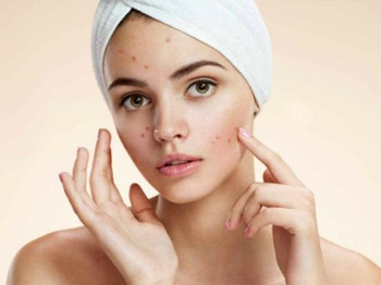 痘疤怎么消除小妙招,招招治痘印 去痘印 美白祛黄 第1张 痘疤怎么消除小妙招,招招治痘印 去痘印 美白祛黄 第1张