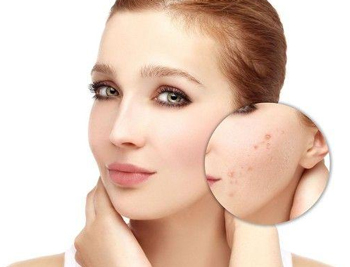 青春痘凹陷疤痕修复方法，教你完美填坑  青春痘 疤痕 美白祛黄 第1张