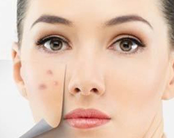 青春痘凹陷疤痕修复方法，教你完美填坑  青春痘 疤痕 美白祛黄 第2张