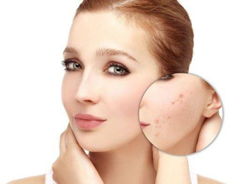 痘疤和痘印的区别，3大方面快速区分  痘印 痘疤 区别 美白祛黄 第1张