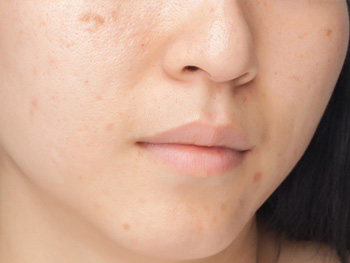 痘疤和痘印的区别，3大方面快速区分  痘印 痘疤 区别 美白祛黄 第2张