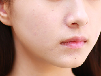 痘疤和痘印的区别，3大方面快速区分  痘印 痘疤 区别 美白祛黄 第3张