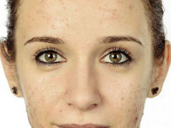 痘印一般多久会消失，分析3种原因  去痘印 美白祛黄 第2张