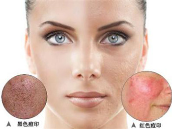 痘印一般多久会消失，分析3种原因  去痘印 美白祛黄 第4张