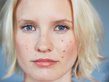 痘印变黑了怎么办，4种方法快速淡化