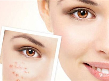 酸奶去痘印法这是个十分简单的小妙招  去痘印 美白祛黄 第2张