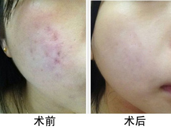 激光祛痘印是永久的吗，看过就知道  祛痘印 美白祛黄 第3张