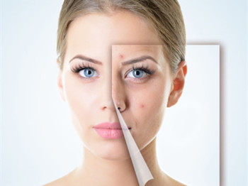 马油去痘印效果怎么样，关于痘印那些事  去痘印 美白祛黄 第2张