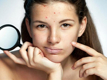 马油去痘印效果怎么样，关于痘印那些事  去痘印 美白祛黄 第4张