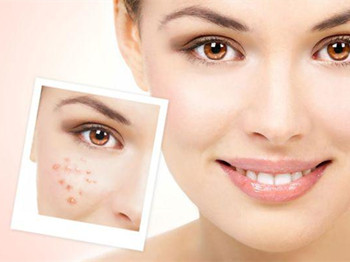 2020最新痘印怎么消除小妙招，八招改善肌肤