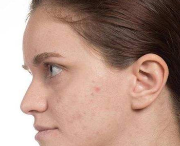 脸严重缺水补不进去水怎么办