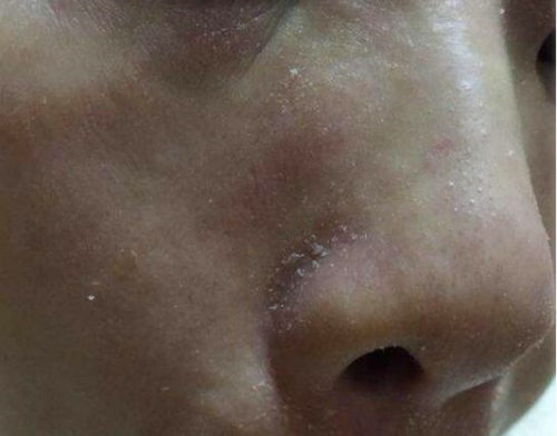 过年脸上严重脱皮怎么办，这几个小妙招来帮忙
