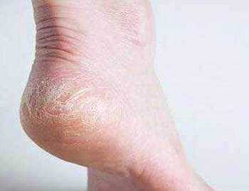 裂脚后跟有什么好偏方，五个偏方治愈脚后跟干裂