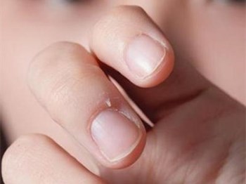 手部起倒刺是什么原因怎么办  倒刺 手部 怎么办 美白祛黄 第2张